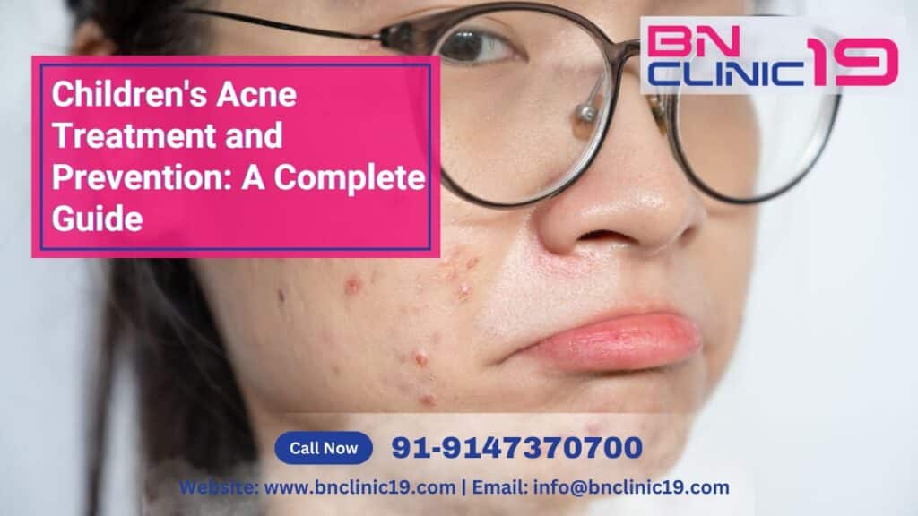 Children's Acne Treatment and Prevention A Complete Guide