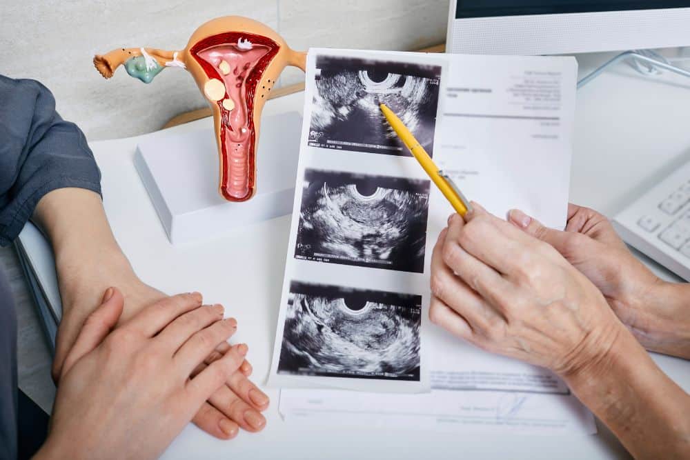 PCOS (Polycystic Ovary Syndrome)