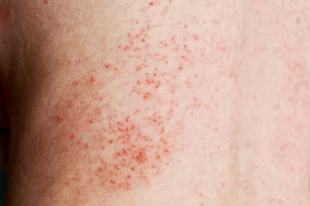 Skin Infections