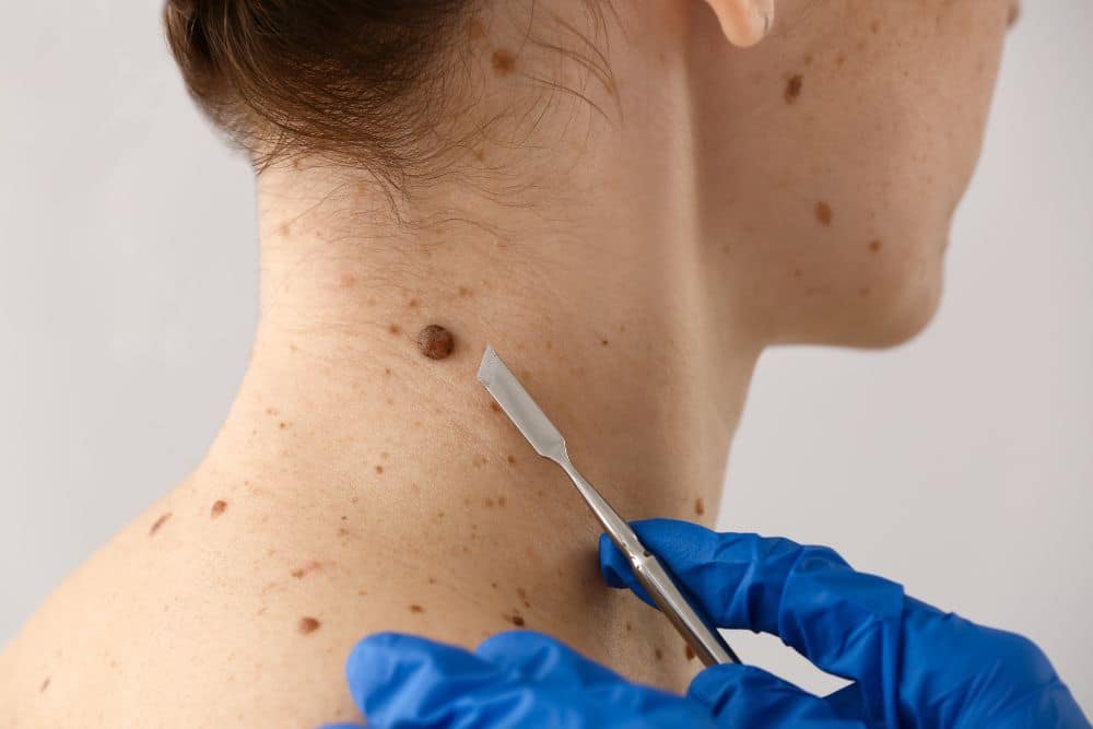 Wart, Mole & Skin Tag Removal